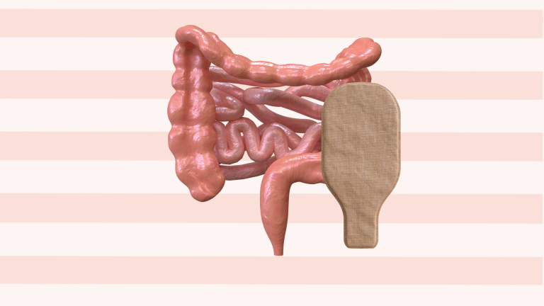 Margot-stoma