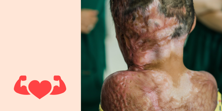 Kinderbrandwondencentrum Kaapstad Fietsen goede doel