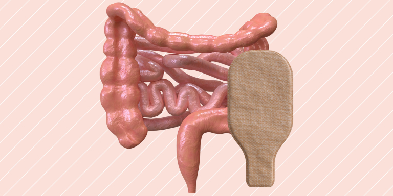 Margot-stoma